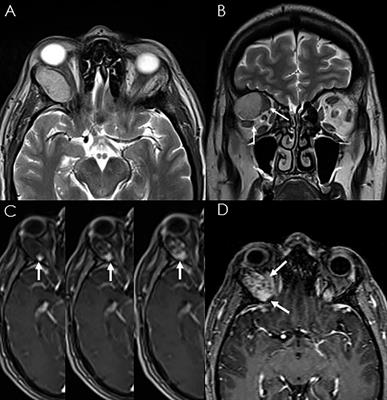 Endoscopic transorbital eyelid approach for the removal of an extraconal cavernous venous malformation: Case report